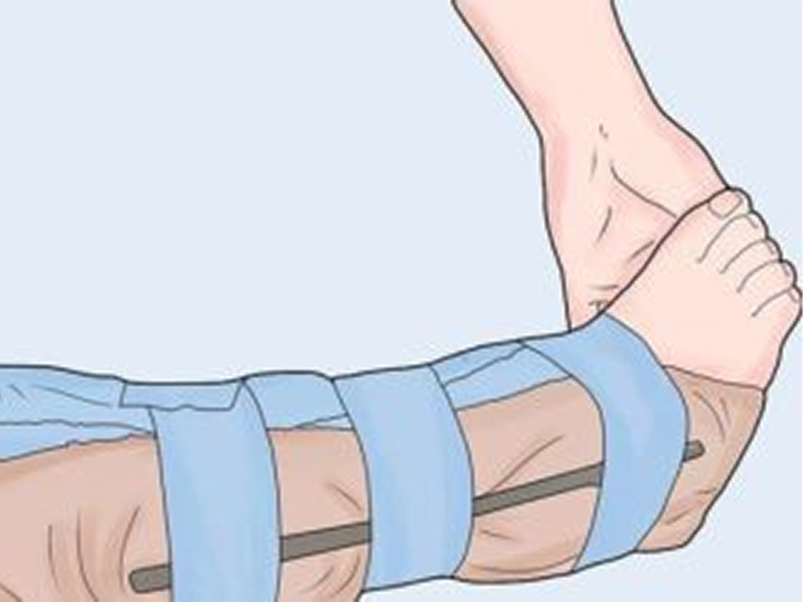 كسر أو التواء